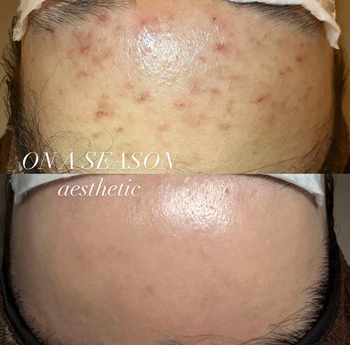 Before and after forehead acne extraction and trouble care at ONASEASON, Busan
