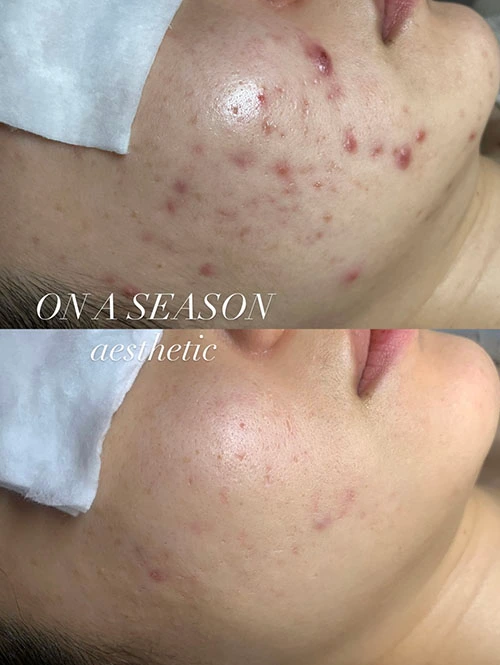 Cheek acne sebum extraction and redness soothing treatment at ONASEASON Seomyeon