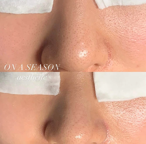 Nose blackhead removal and pore tightening results at ONASEASON, Busan
