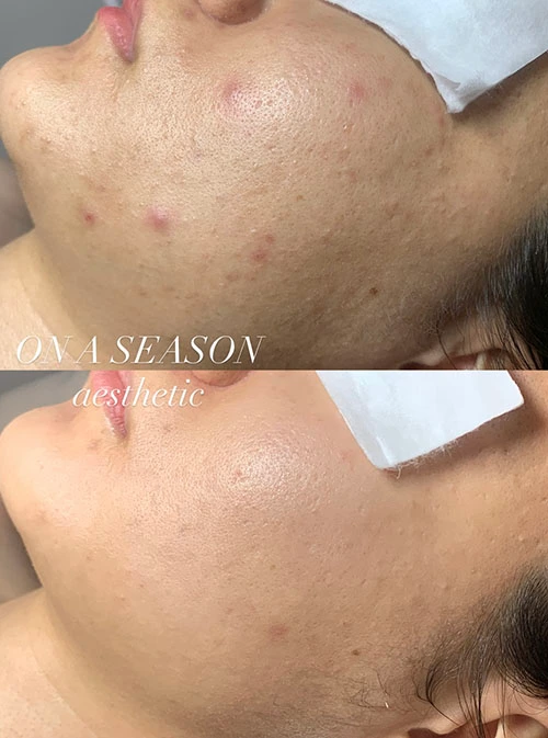 Whiteheads clearing care on the cheeks and skin texture improvement at ONASEASON